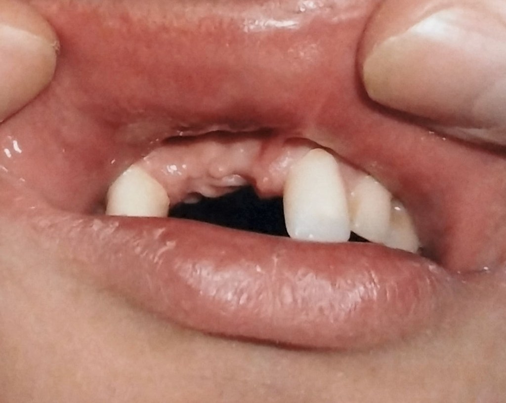 
A close-up of my missing teeth
